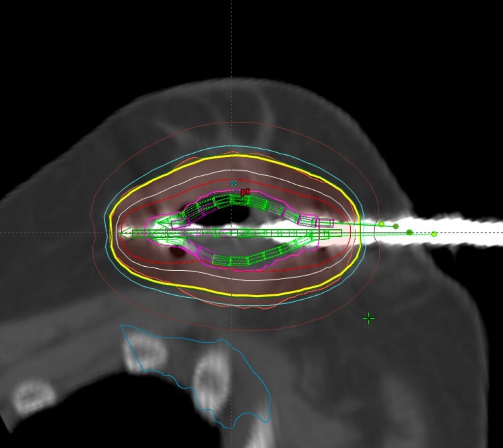 accelerated partial breast irradiation